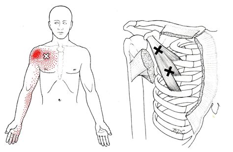 pectoralis minor pain near armpit